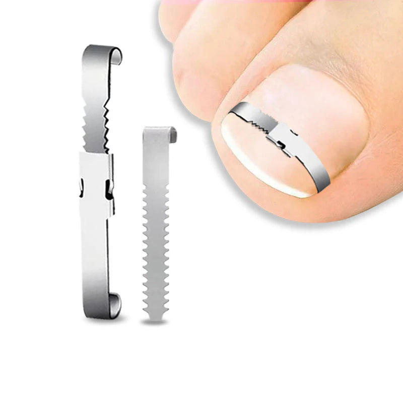 Ingrown Toenail Corrector Tools