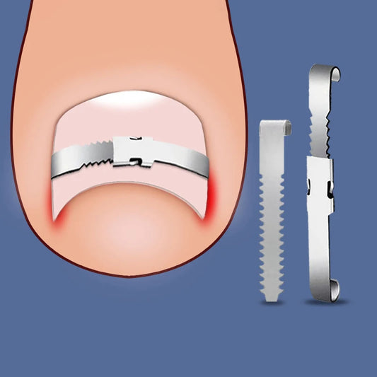 Ingrown Toenail Corrector Tools